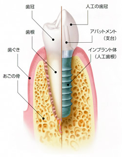 インプラント